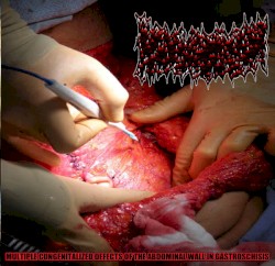Multiple Congenitalized Defects Of The Abdominal Wall In Gastroschisis