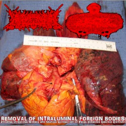 Removal Of Intraluminal Foreign Bodies: Internal Intestinal Bypass And Manual Extraction Of Fecal Impacted Gastric Contents