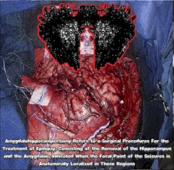 Amygdalohippocampectomy Refers To A Surgical Procedures For The Treatment Of Epilepsy, Consisting Of The Removal Of The Hippocampus And The Amygdalae, Indicated When The Focal Point Of The Seizures Is Anatomically Localized In These Regions