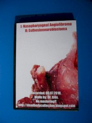 Laryngeal Carcinoma