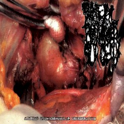 Ataxias Spinocerebellar Degeneration