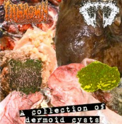 A Collection Of Dermoid Cysts