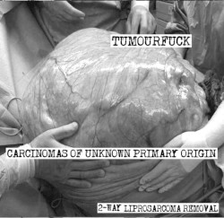 2-way Liprosarcoma Removal