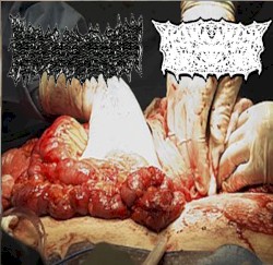 Bowel Fermentation / Acute Tracheal Stenosis
