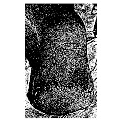 Traumatic Amputations III