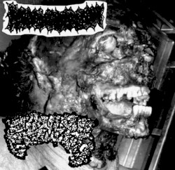 Bowel Fermentation / Epidural Hematoma