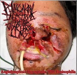 Angiolymphoid Hyperplasia With Eosinophilia