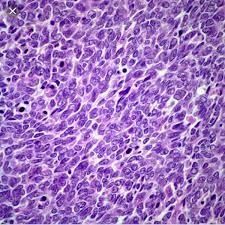Small Cell Carcinoma EP