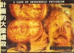 A Case of Orthopedic Fetishism