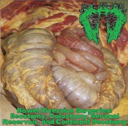 Bowel Diversion Surgeries: Ileostomy, Colostomy, Ileoanal Reservoir, And Continent Ileostomy