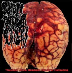 Traumatic Acute Metastatic Subdural Hematoma