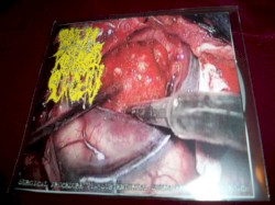 Surgical Procedure Via Subtentorial Supracerebellar Approach