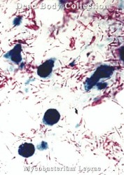 Mycobacterium Leprae